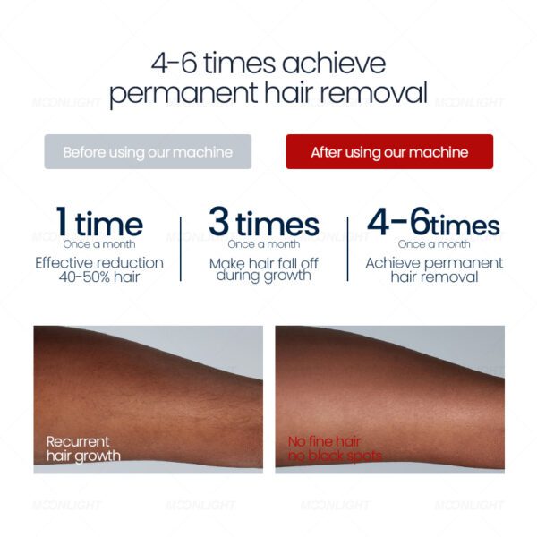 3-6 sessions of permanent laser hair removal