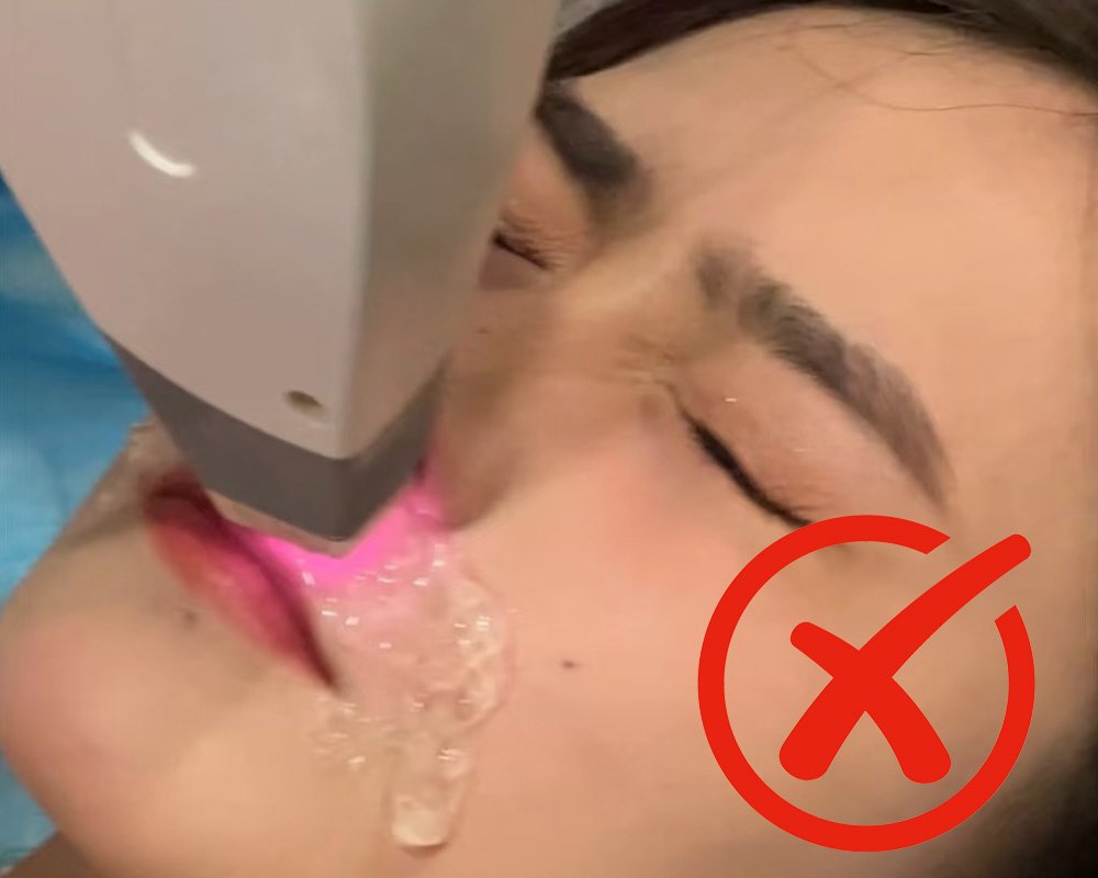 Other laser hair removal machines