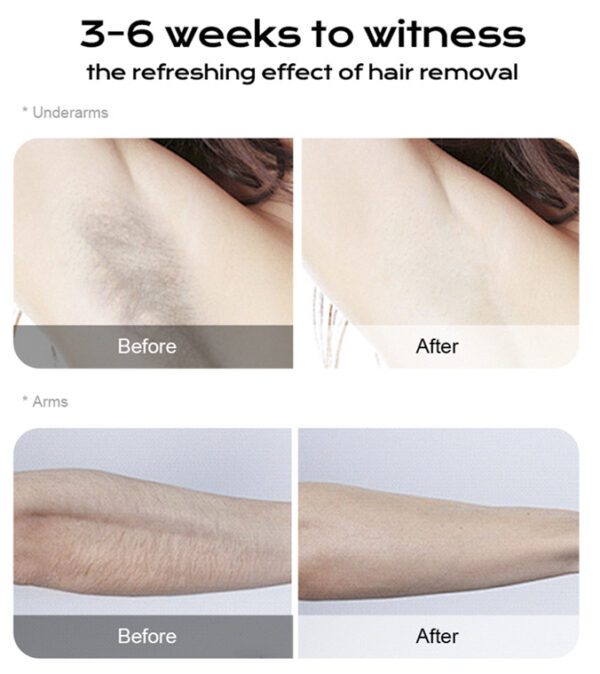 Portable laser hair removal machine treatment