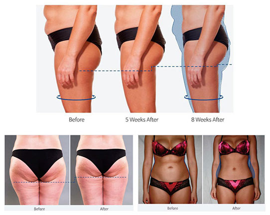 Ems Body Sculpt Machine Before and After