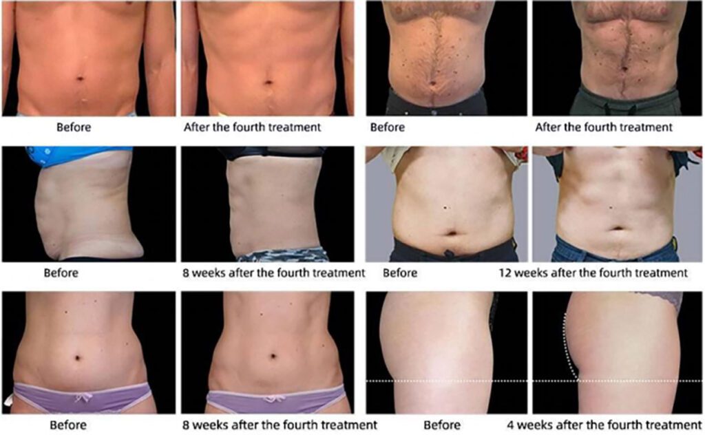 Ems Body Sculpt Machine Before and After