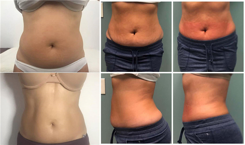 Cryoskin Machine Before and After