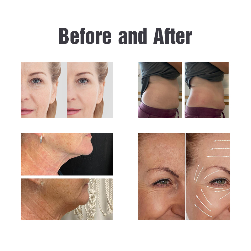 Cryoskin Machines Before and After
