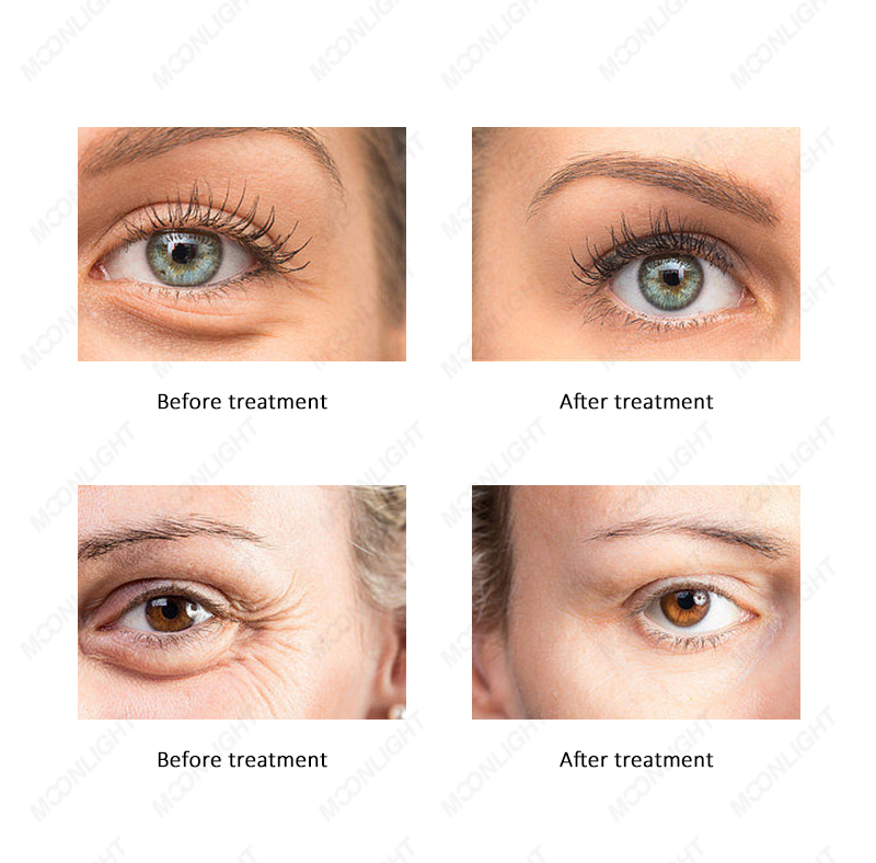 Endosphere Machine Before and After