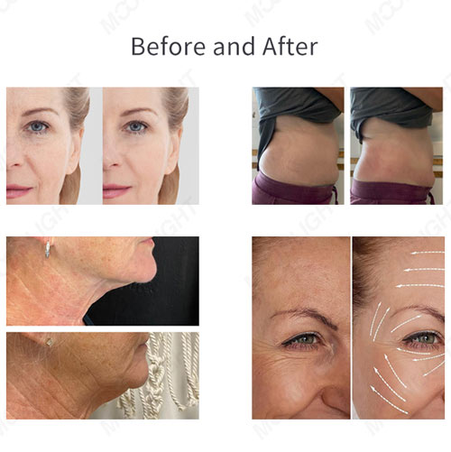 Cryoskin Machine Before and After