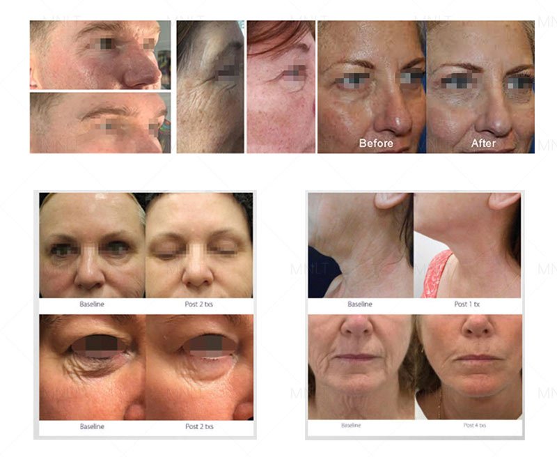 Fusion plasma device before and after