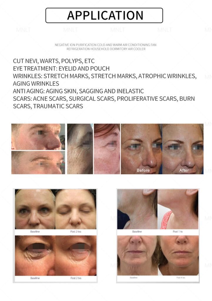 fusion plasma machine