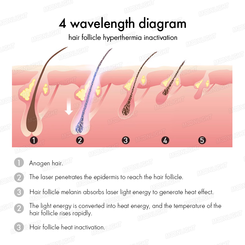 How does laser hair removal work