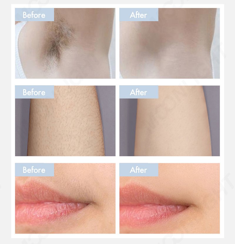 oem laser hair removal machine before and after