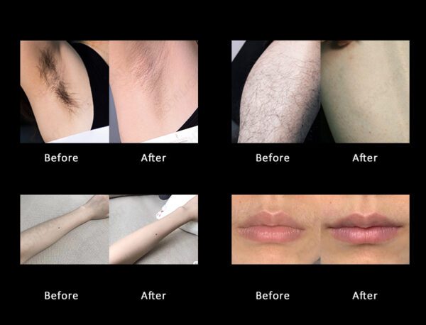 Comparison of the effect of diode laser hair removal machine before and after