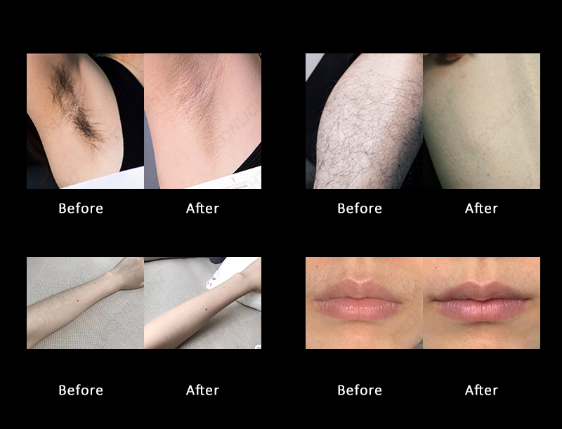 Comparison of the effect of diode laser hair removal machine before and after