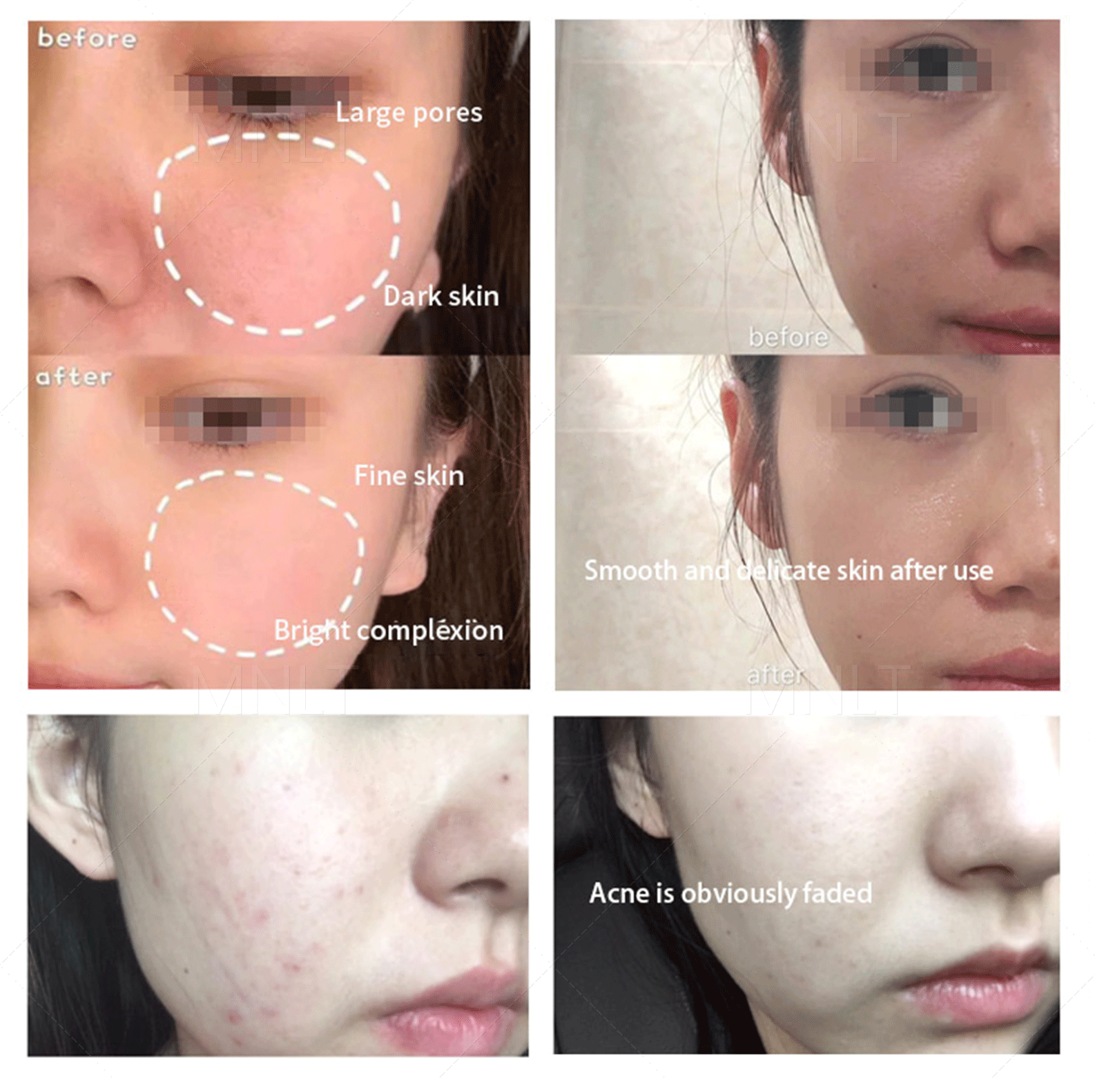 12 in 1 Hydra Dermabrasion Facial Machine