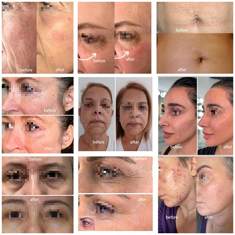 Comparison of the treatment effect of cold plasma