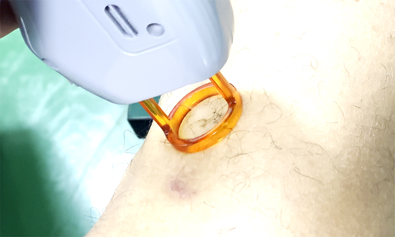 alexandrite laser hair removal machine