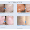 Microdermabrasion