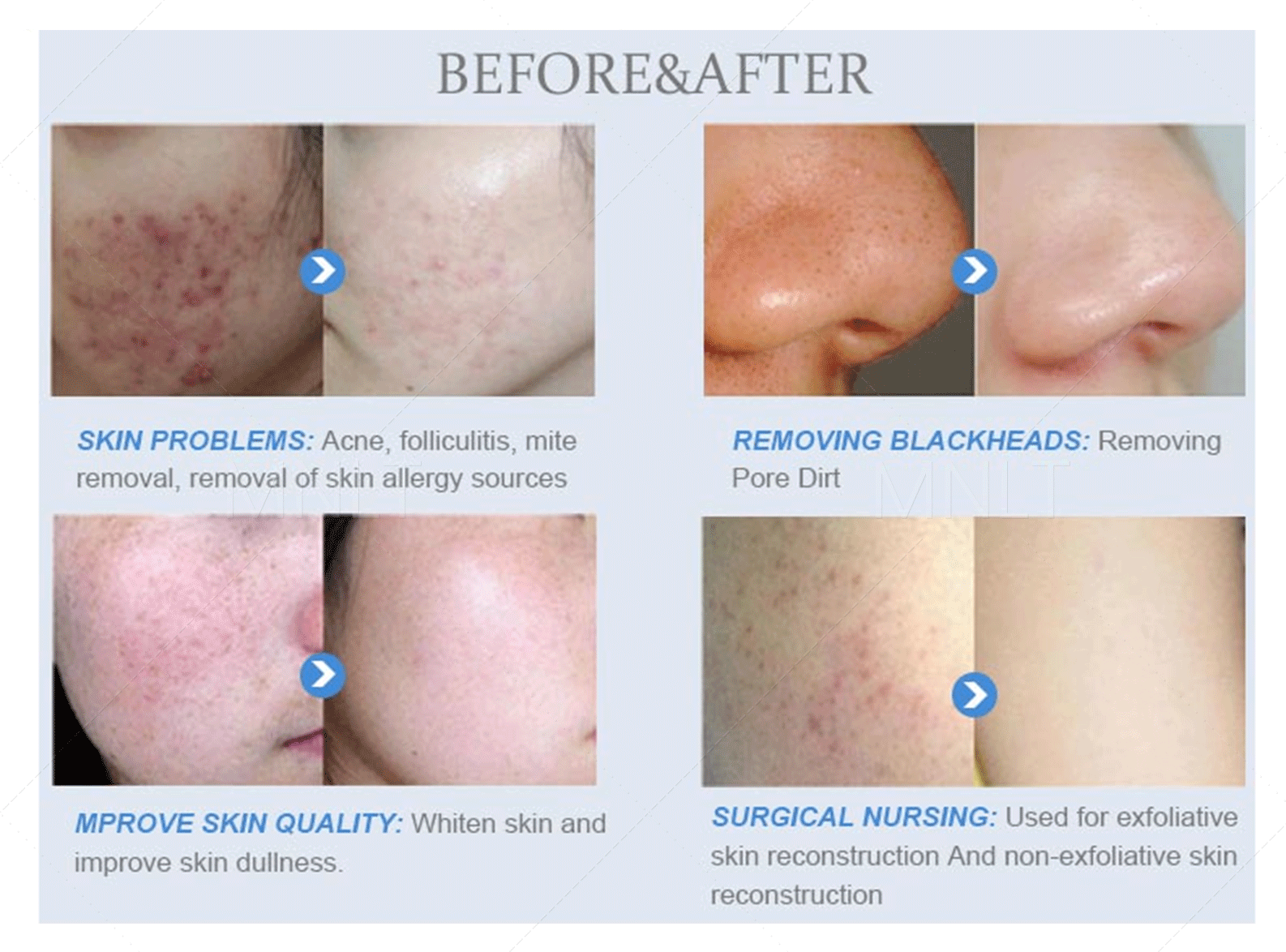 Microdermabrasion