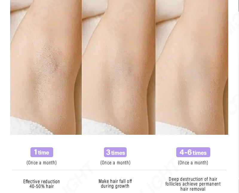 Laser hair removal treatment before and after