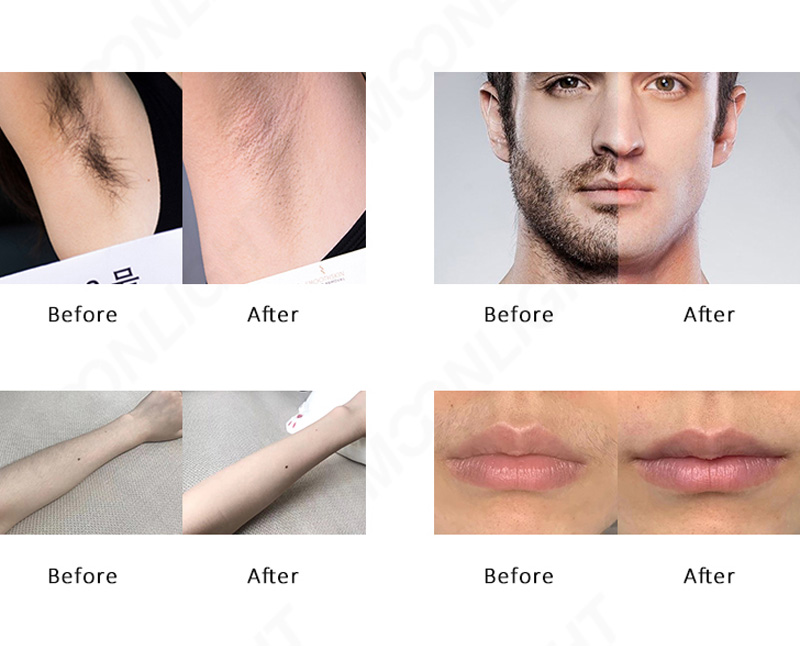 Laser hair removal before and after