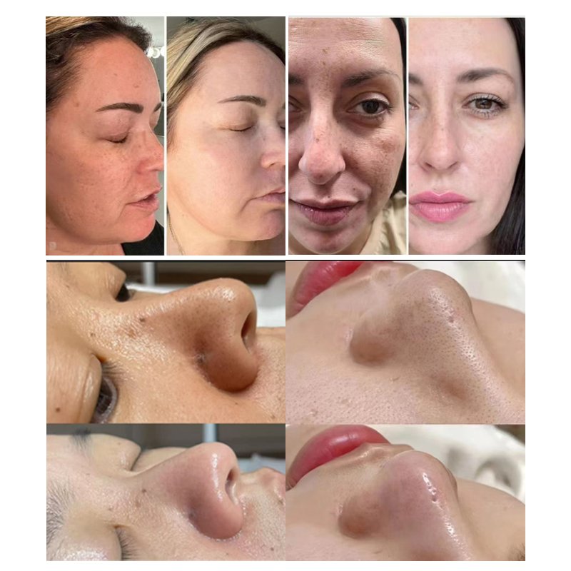 Bubble Hydra Oxygen Dermabrasion Facial Before and After