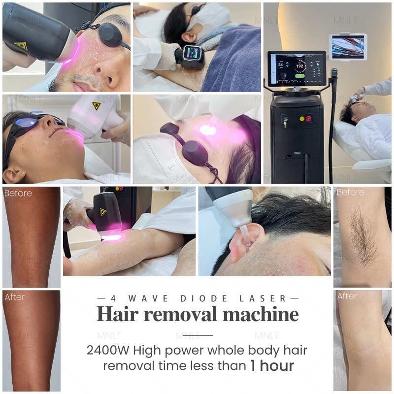 Which Areas Can Be Treated with Laser