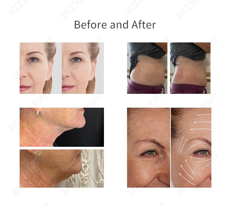 Cryoskin Cellulite Treatment