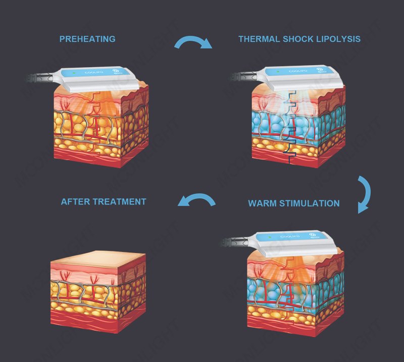 How Does Cryoskin Work on Cellulite