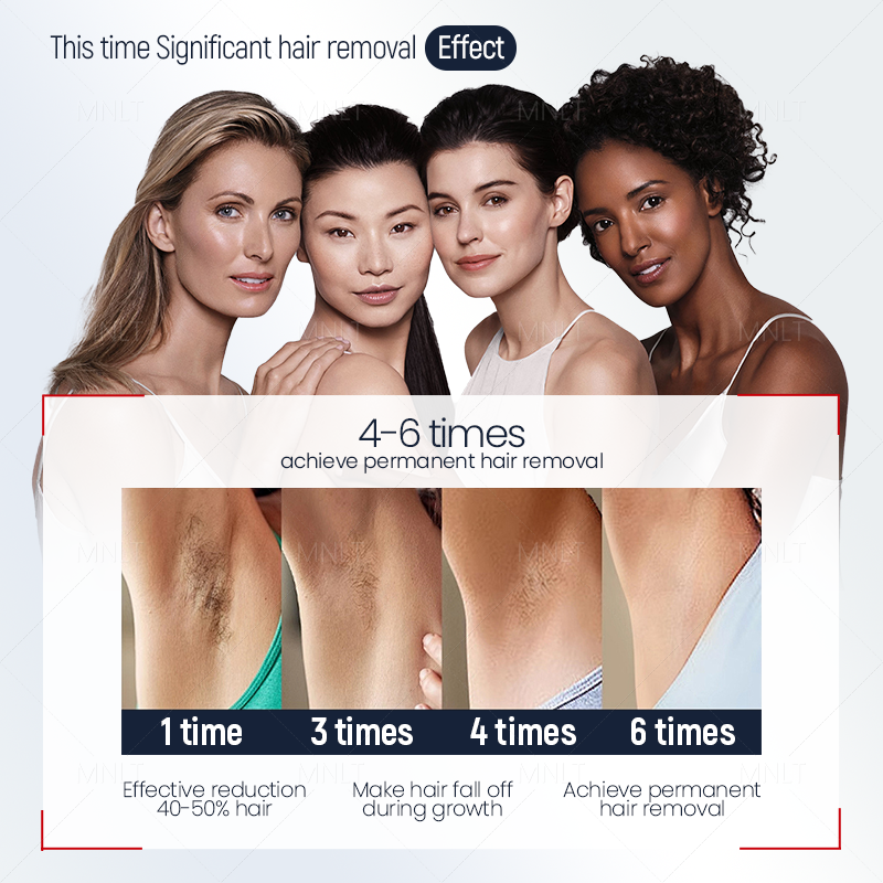 After 4–6 sessions: Up to 90% permanent reduction