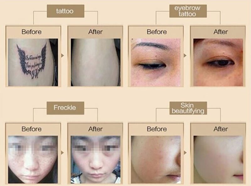 Best Tattoo Removal Machines for Clinics in 2026: Complete Buyer's Guide