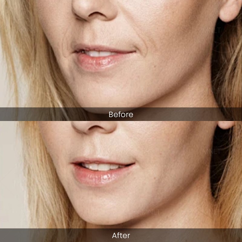 Endolift Before and After – Treatment Results
