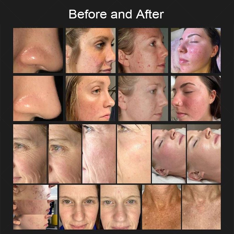 Comparison of Fusion Plasma treatment before and after