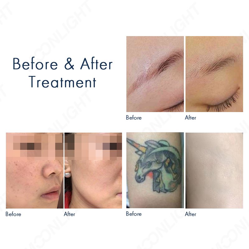 ND YAG Laser Before and After