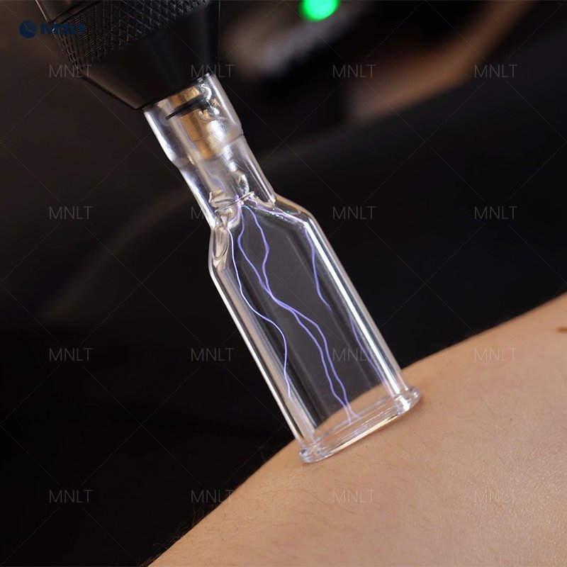 Fusion Plasma treatment