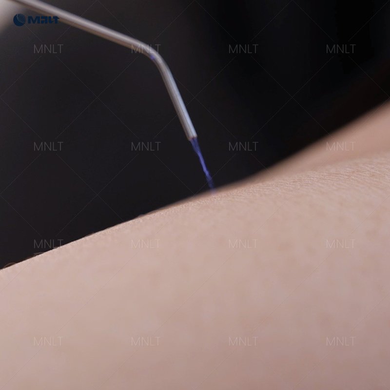 Fusion Plasma treatment