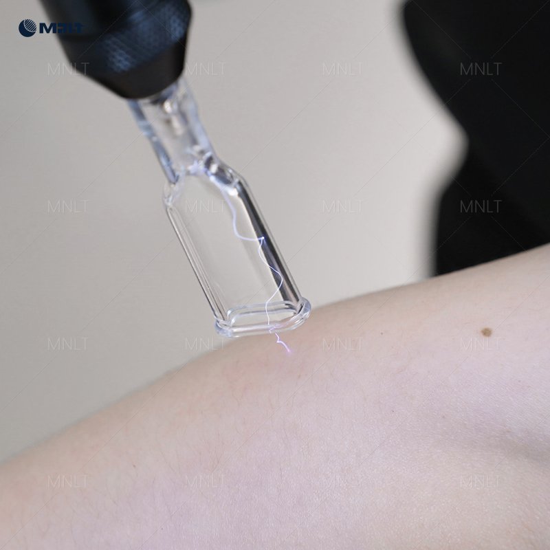 Fusion Plasma treatment