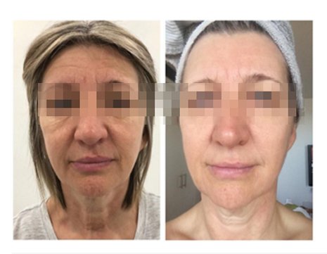 HIFU Before and After