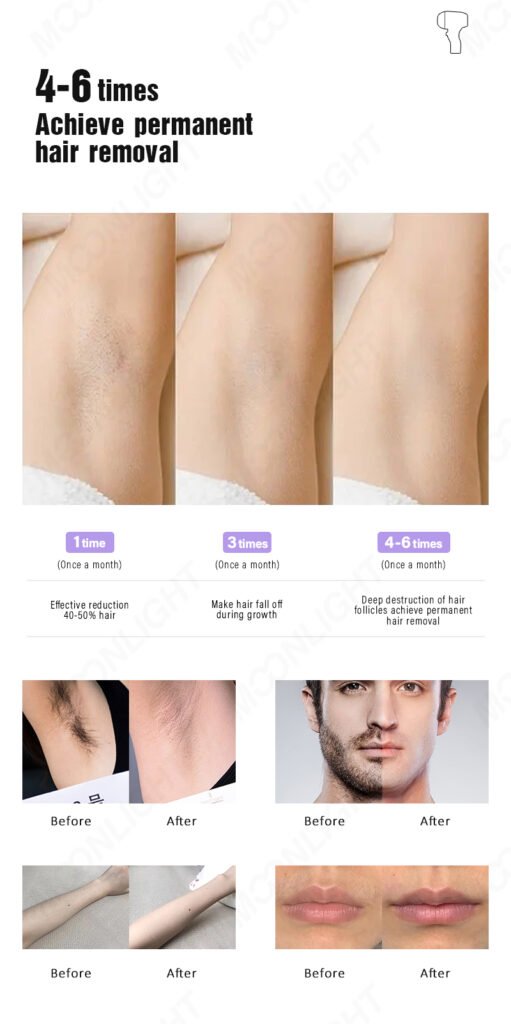 Diode laser permanent hair removal results