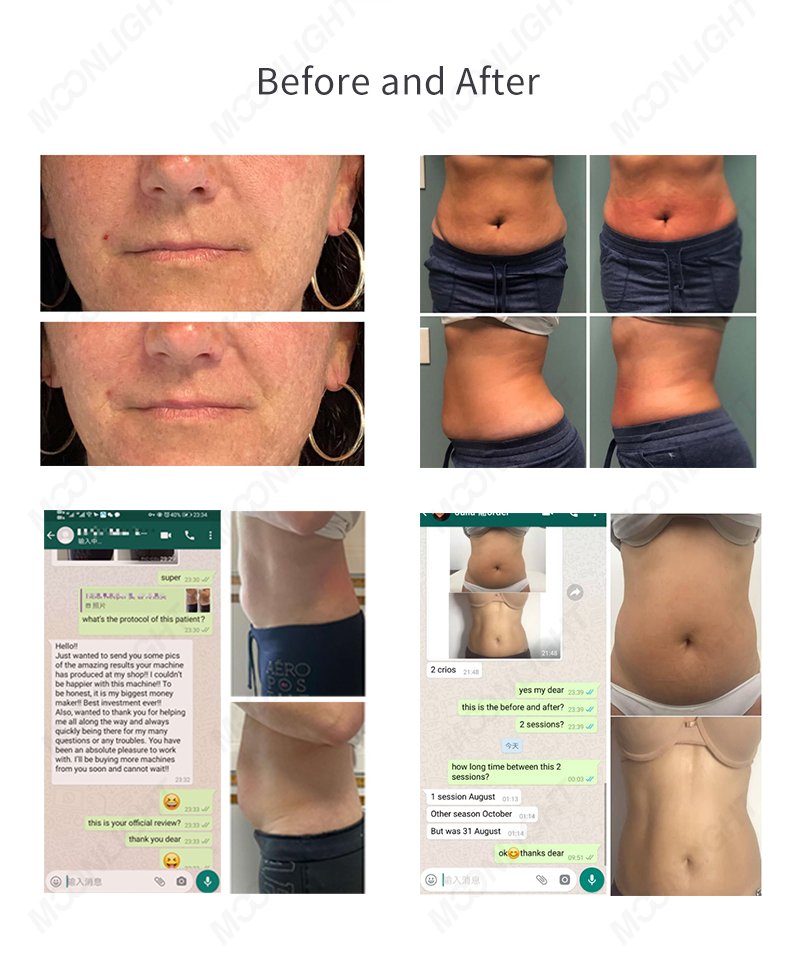 Cryoskin before and after results