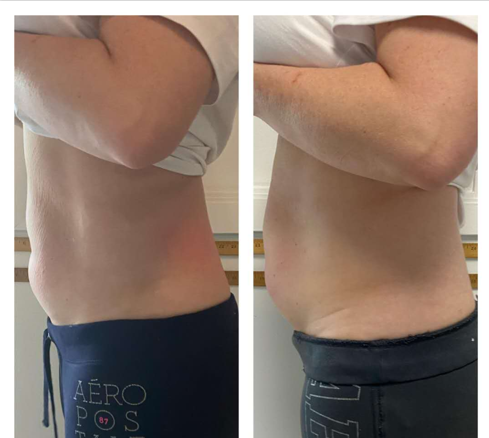 Cryoskin before and after