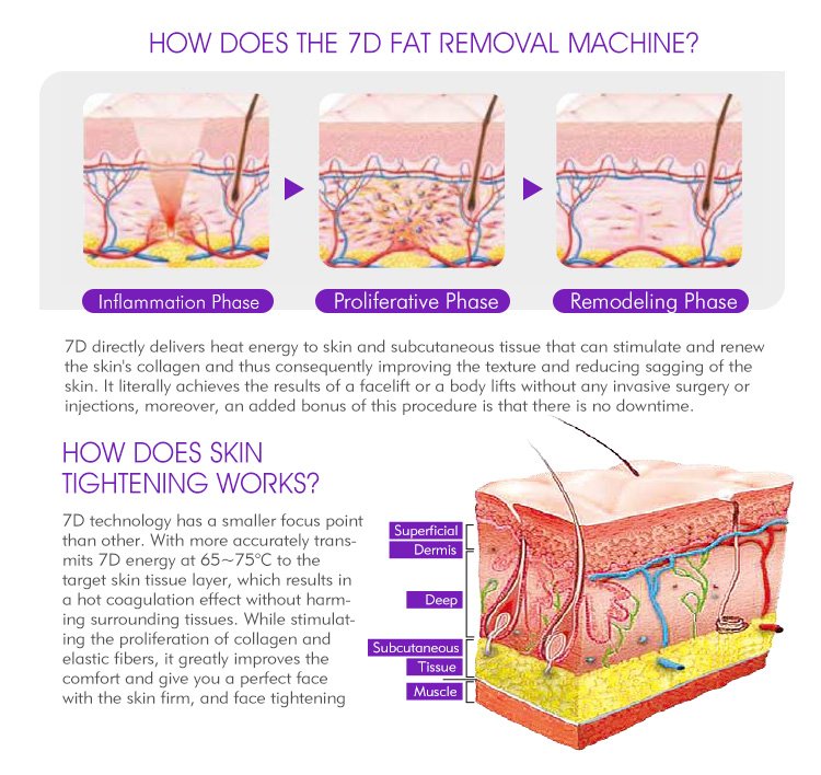 How HIFU Technology Works