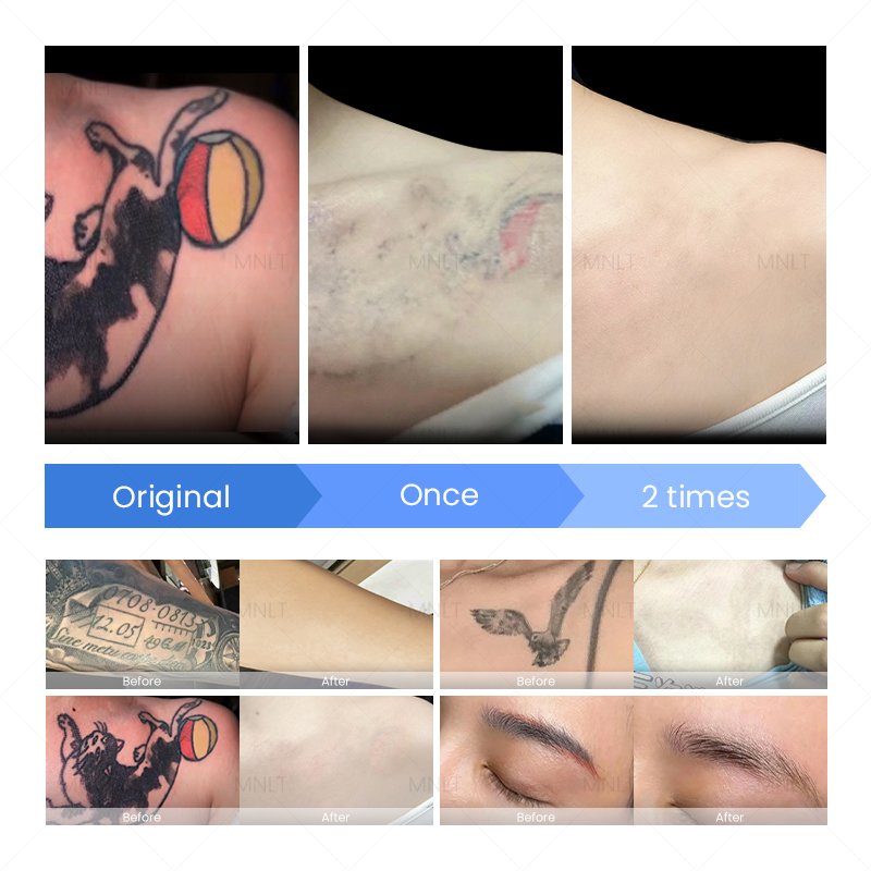 Before and After Nd:YAG Laser Treatment